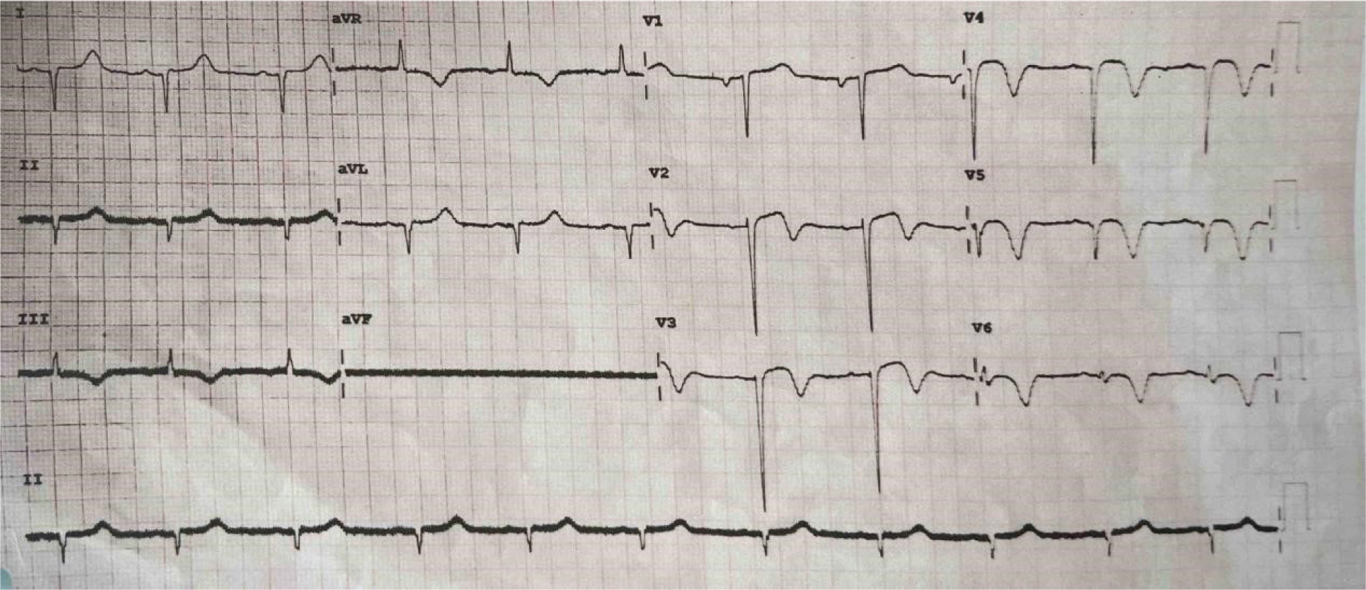 Lateral Ischaemia Ecg